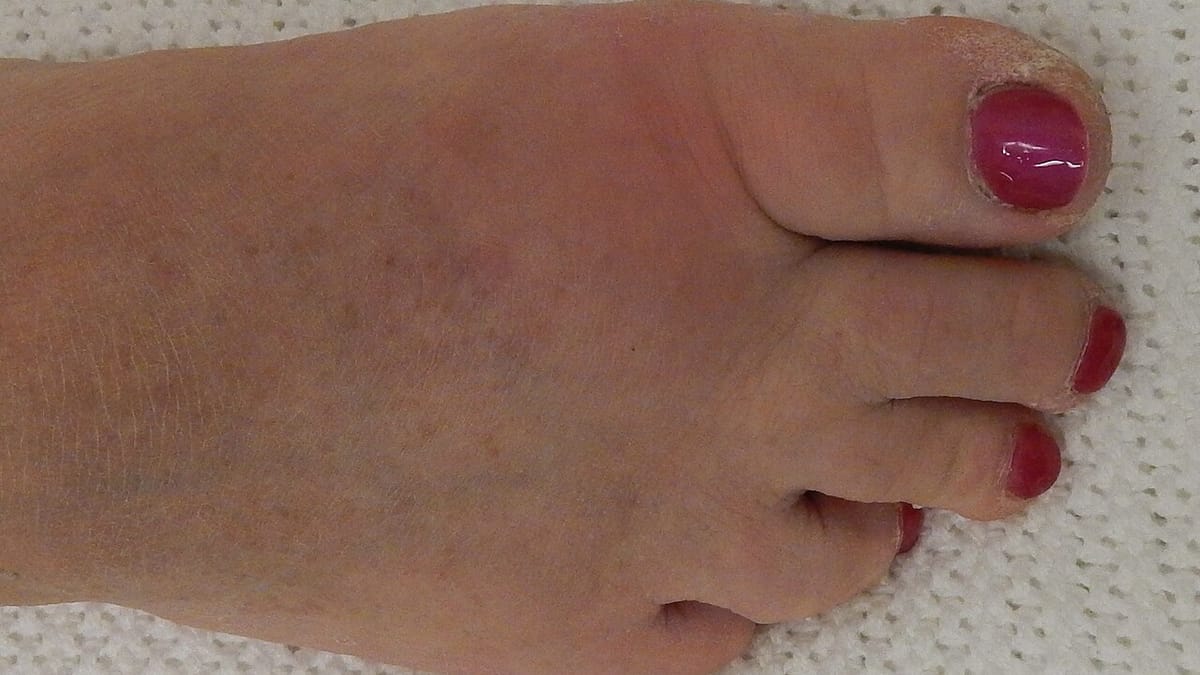 Kaki perempuan berkuteks merah dengan sendi pangkal ibu jari yang bengkak akibat gout.