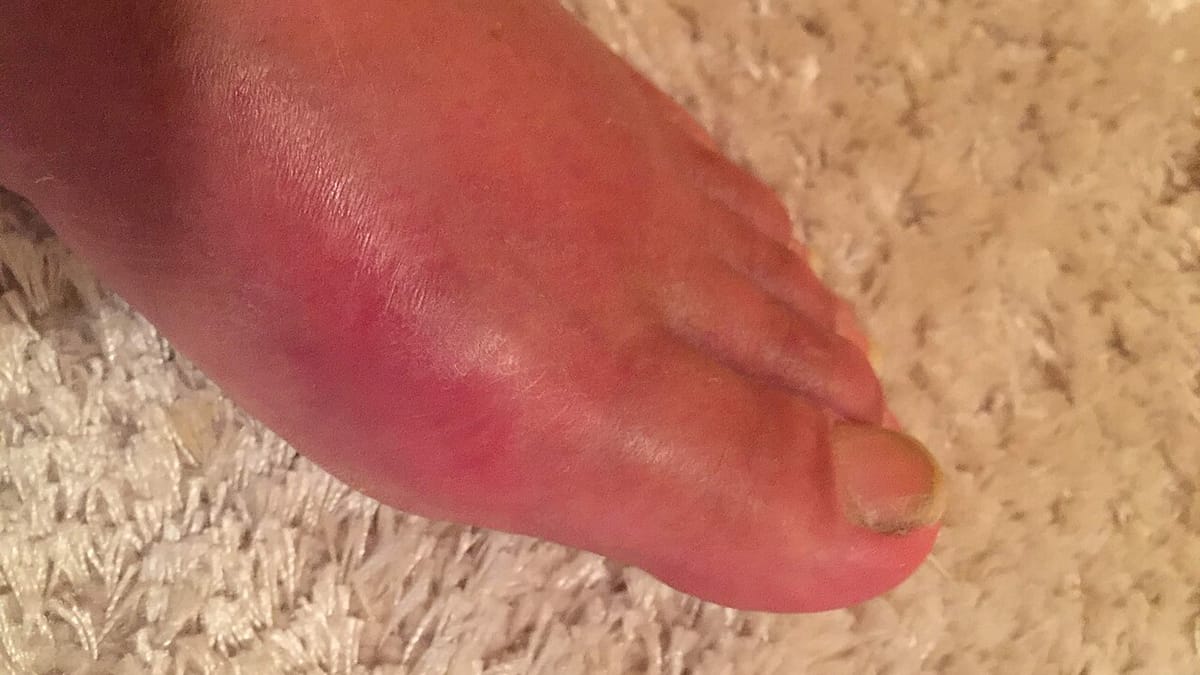 Pangkal ibu jari kaki tampak bengkak dan kemerahan saat serangan gout.