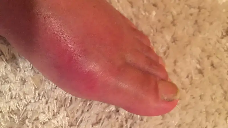 Pangkal ibu jari kaki tampak bengkak dan kemerahan saat serangan gout.